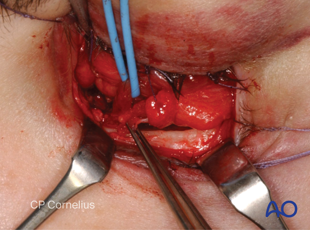 Combination of inferior and medial transconjunctival