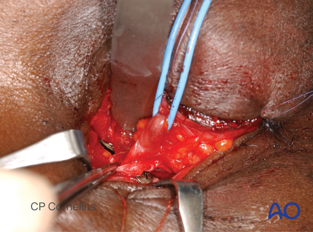 Combination of inferior and medial transconjunctival