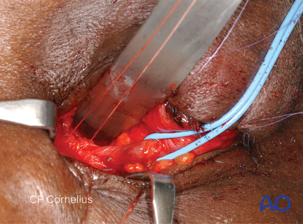 Combination of inferior and medial transconjunctival