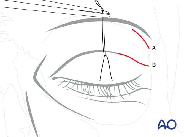 Approaches to the superolateral orbital rim