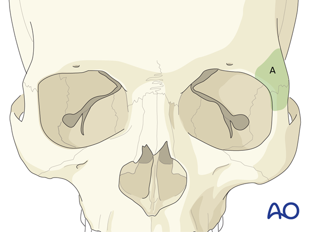 Access area via the lateral eyebrow approach.