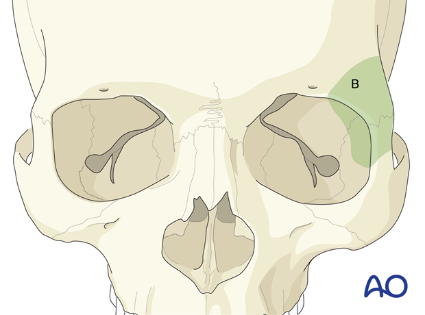 Access area via the upper-eyelid or upper blepharoplasty approach.