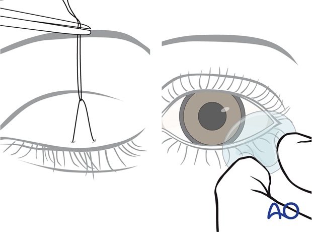 Inserting a corneal shield.