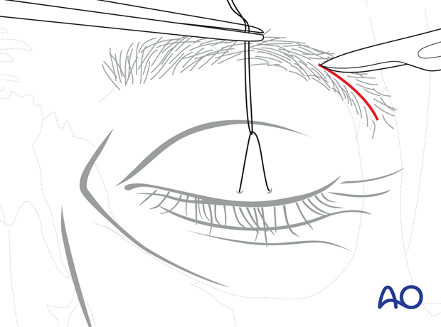 Skin incision – lateral eyebrow approach.