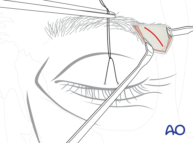 Access to the periosteum – lateral eyebrow approach.