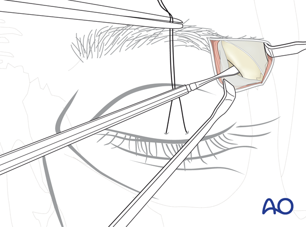 Freeing the underlying bony structures using sharp periosteal elevators – lateral eyebrow approach.