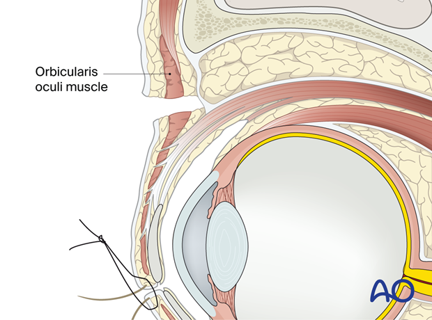 Cross-section showing access for the upper-eyelid approach.