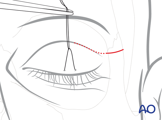 Planned skin incision – upper eyelid approach.