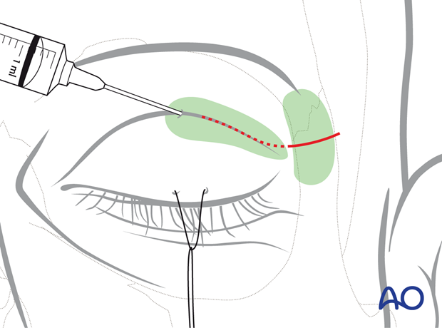 Vasoconstriction – upper eyelid approach.