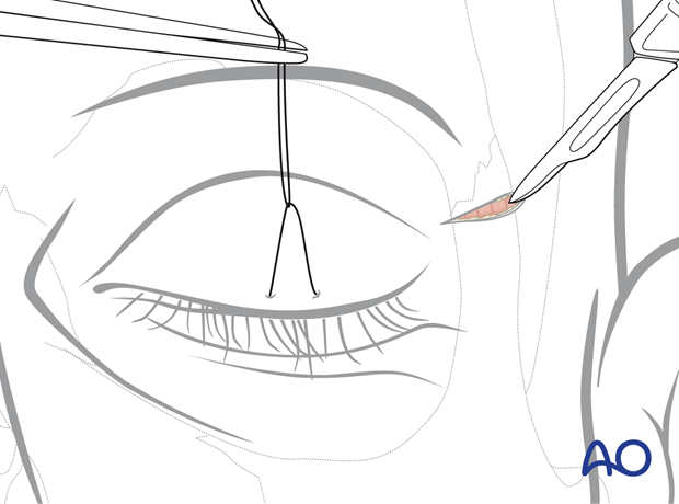 Initial skin incision through a supratarsal fold and the underlying orbicularis oculi muscle – upper eyelid approach.