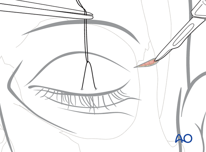Upper eyelid approach