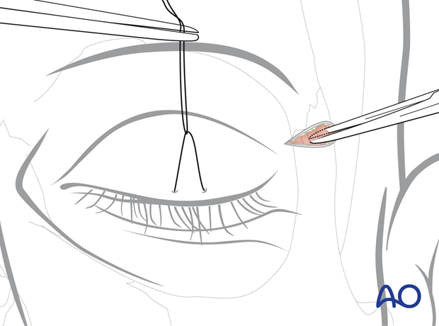 Upper-eyelid approach 