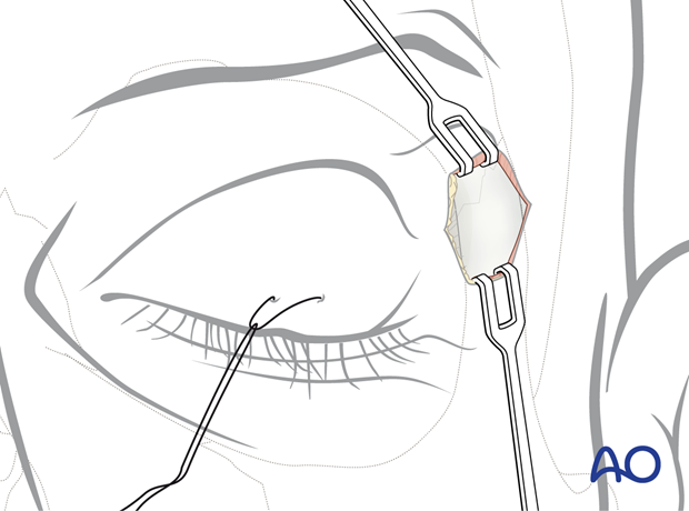 Superolateral rim with exposure of the periosteum – upper eyelid approach.