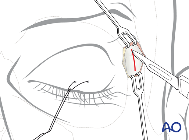 Periosteal incision – upper eyelid approach.