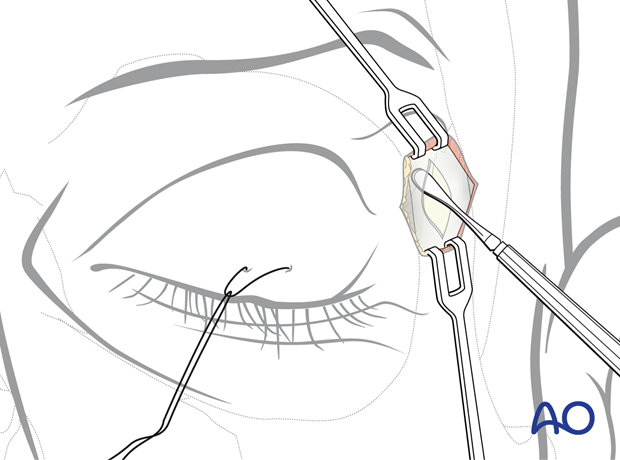 Using sharp periosteal elevators to expose the bony structures – upper eyelid approach.