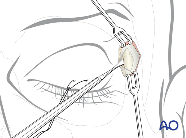 Reflecting the periosteum – upper eyelid approach.