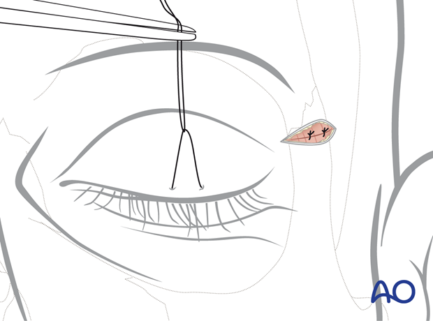 Orbicularis oculi muscle reapproximated with interrupted sutures – upper eyelid approach.