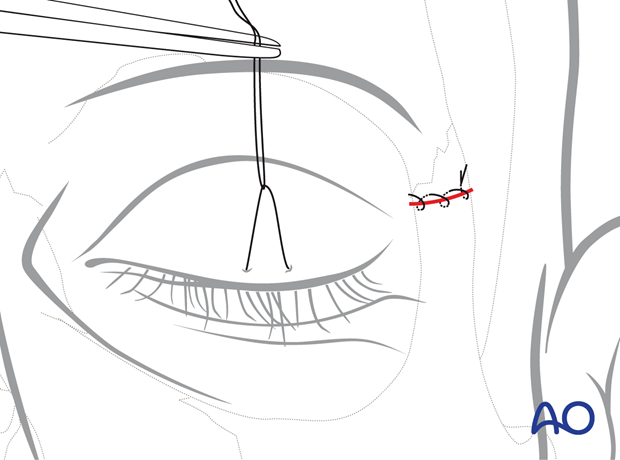 Skin closure – upper eyelid approach.