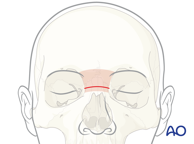 Location of skin incision – glabellar approach.