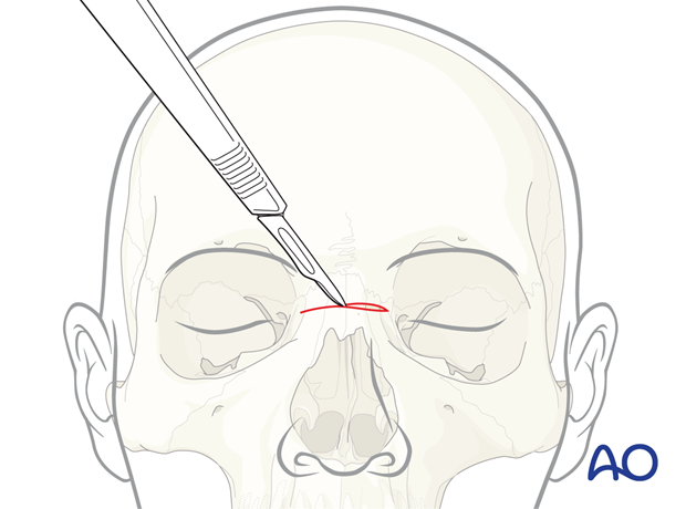 Skin incision – glabellar approach.