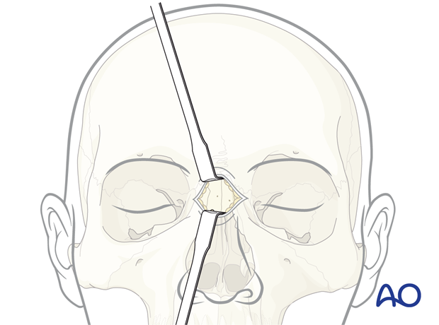 Exposure of the bone – glabellar approach.