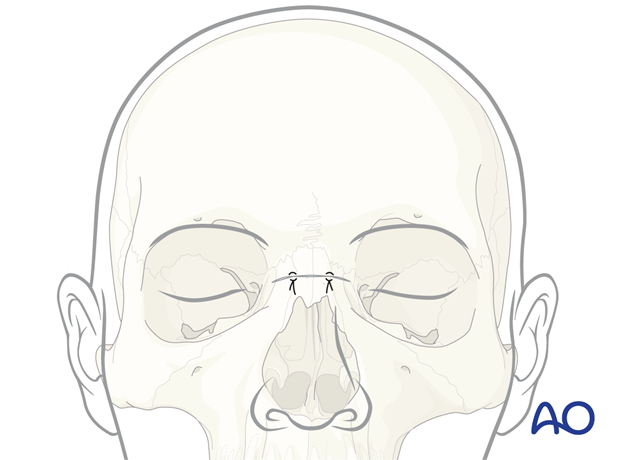 Wound closure – glabellar approach.