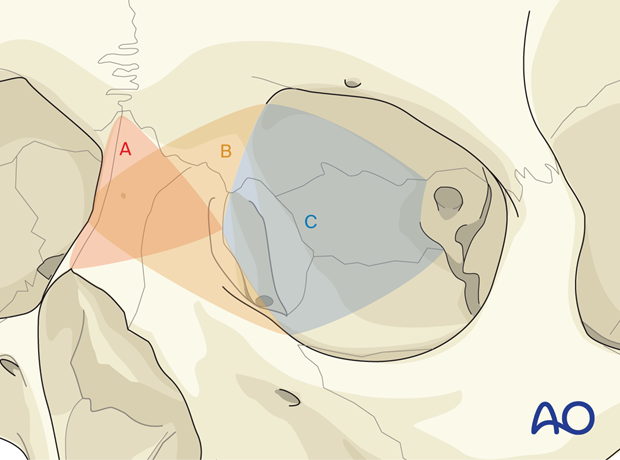 Access areas – extended glabellar approach.