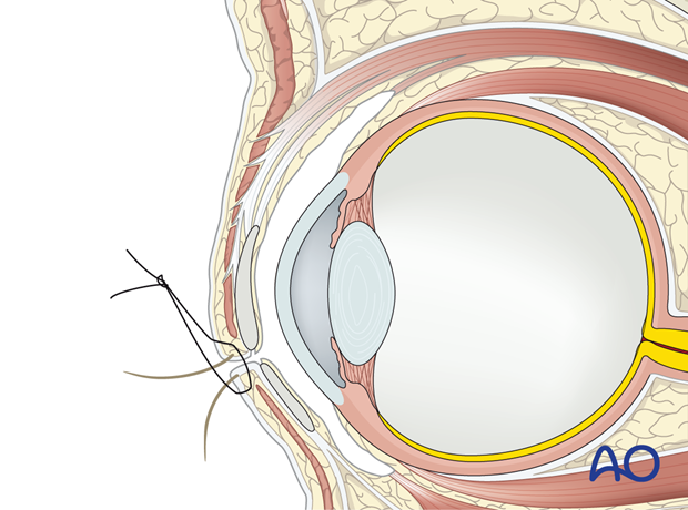 Temporary tarsorrhaphy – extended glabellar approach.