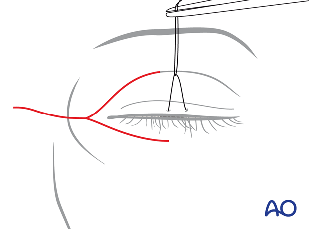 Extended glabellar approach