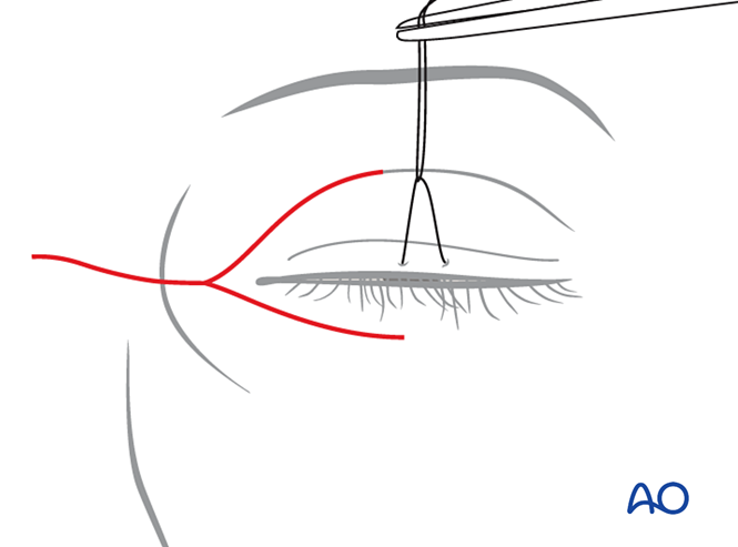 Extended glabellar approach (horizontal Y approach)