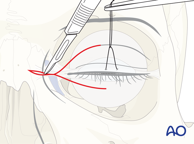 Skin incision – extended glabellar approach.