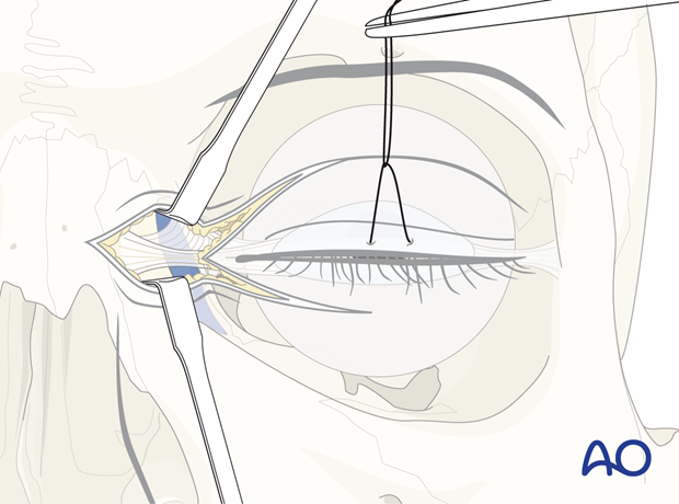 Identifying the canthal tendon – extended glabellar approach.