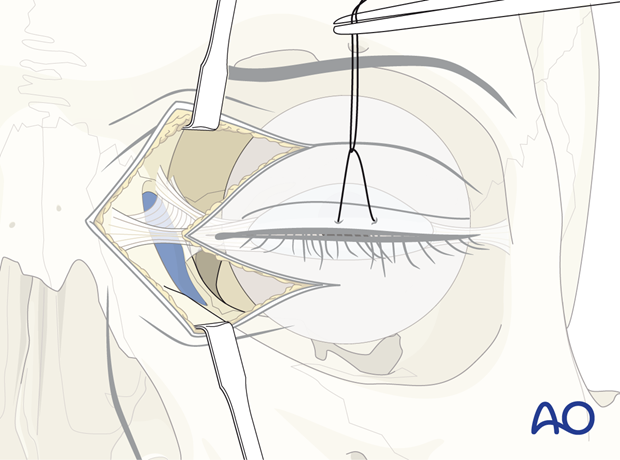 Exposing the fractures – extended glabellar approach.