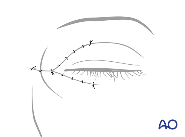 Wound closure – extended glabellar approach.