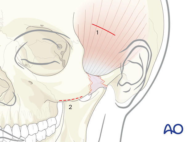 Incision sites for the temporal or Gliilies and transoral or Keen approaches.