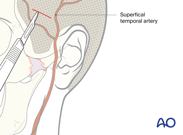 Temporal incision – temporal or Gillies approach.