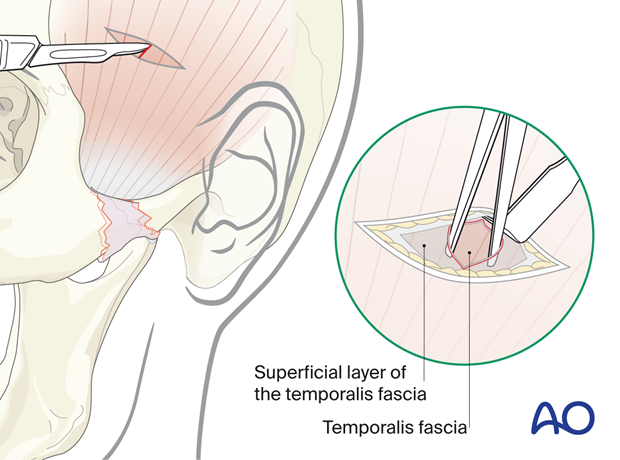 Dissection down to the deep temporal fascia – temporal or Gillies approach.