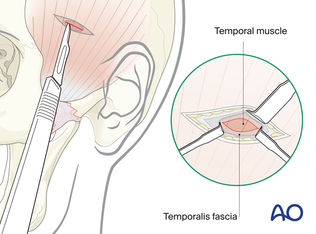 Incising the fascia to expose the temporalis muscle – temporal or Gillies approach.