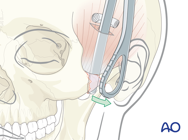 Applying outward force with a Rowe zygomatic elevator – temporal or Gillies approach.