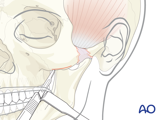 Intraoral incision – transoral or Keen approach.