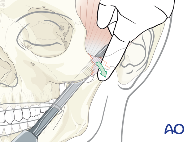 Elevating of the zygomatic arch into its proper position to reduce an isolated zygomatic arch fracture.