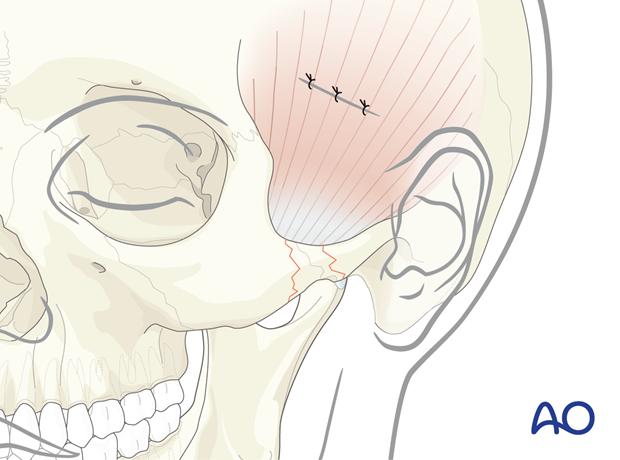 Wound closure – temporal or Gillies approach.