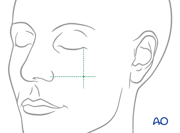 Location of percutaneous hook