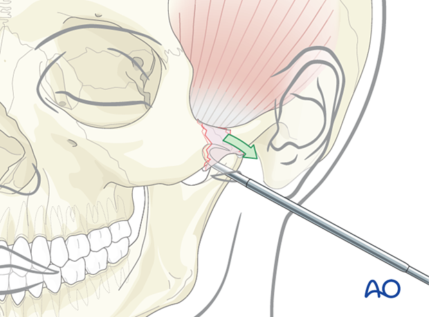 The percutaneous bone hook is placed through the skin around the depressed zygomatic fracture segments and pulled laterally.