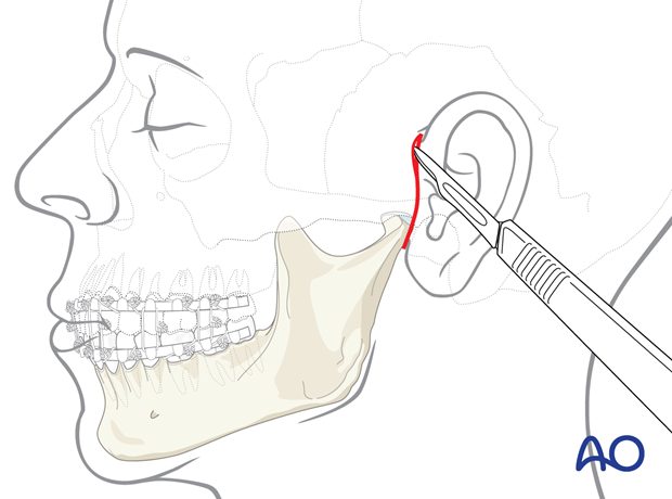 incision in a preauricular skin crease – preauricular approach.