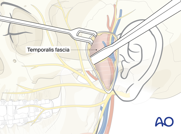 Locating the temporalis fascia – preauricular approach.