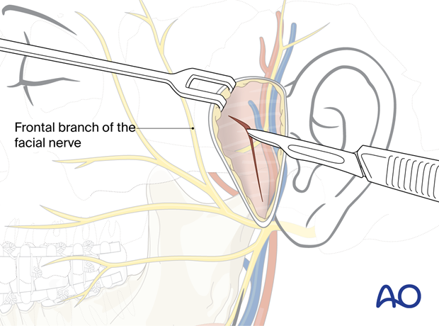 Incising the temporalis fascia – preauricular approach.