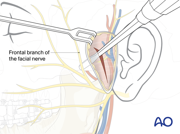 Insert the periosteal elevator beneath the superficial layer of the deep temporal fascia – preauricular approach.