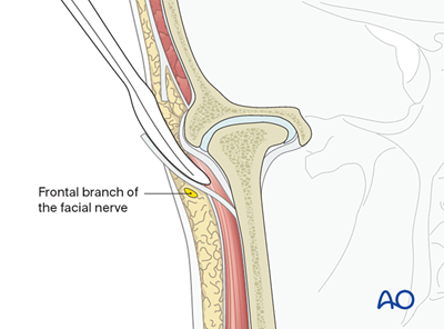Preauricular Incision Steps Preauricular approach