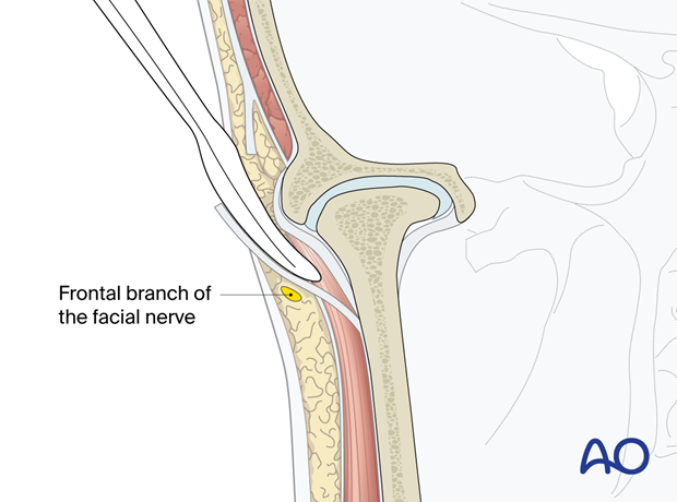 Coronal view of the dissection to the lateral portion of the zygomatic arch and mandibular condyle region – preauricular approach.